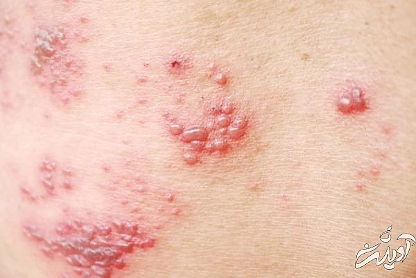 علت بیماری شینگلز بیماری شینگلز